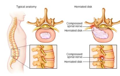 Things To Know About Herniated Disc Injuries And Personal Injury